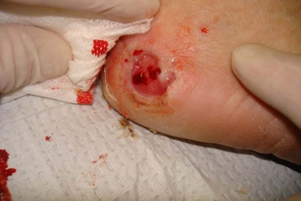 Diabetic foot ulcer