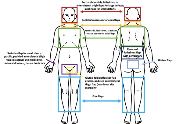 Flaps for coverage of irradiated areas