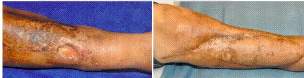 Chronic radiation-induced ulceration of the leg pre and post free flap reconstruction
