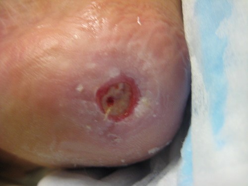 Unstageable PU/PI on right heel 