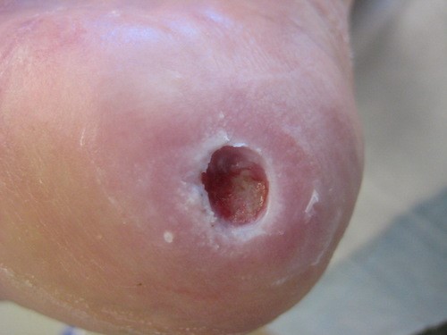 8 weeks after CSWD and appropriate treatment - wound epithelialization 