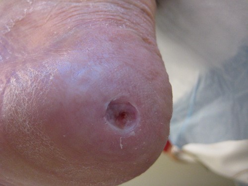 10 weeks after CSWD and appropriate treatment - further epithelialization and healing