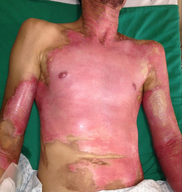 Superficial partial thickness / second degree burn