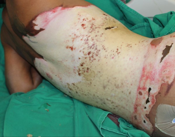 Full thickness/ third degree burn