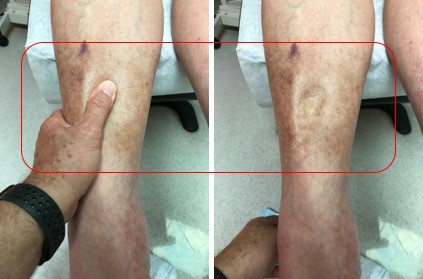 Pitting edema. By Scott Robinson, MD