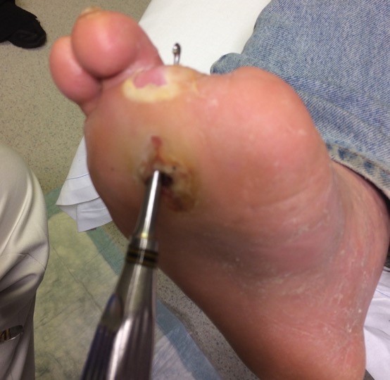 DFU probe-to-bone test