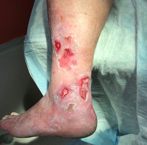 Ensure adequate wound bed preparation and hemostasis        