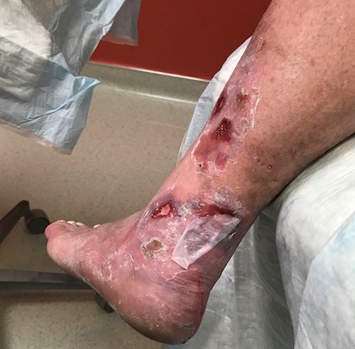 Apply CTP so as to overlap wound edges 