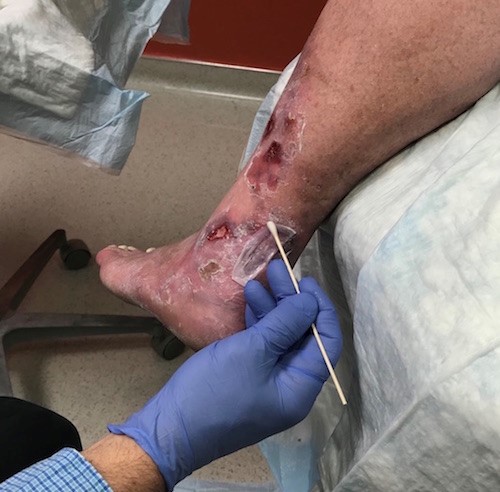 Remove air pockets between the CTP and the wound bed