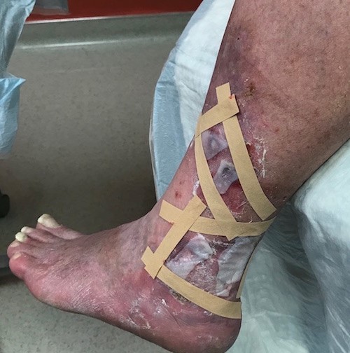  CTP covered with silicone contact layer and secured with skin closure strip