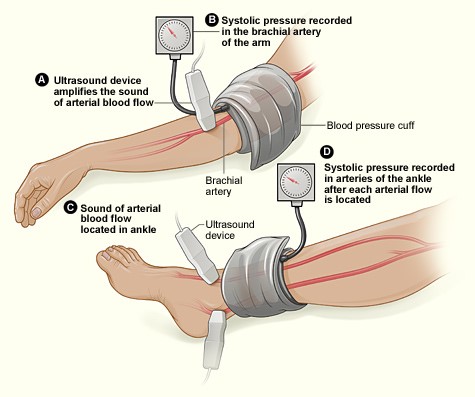 Measuring the ankle brachial index with the Doppler method 