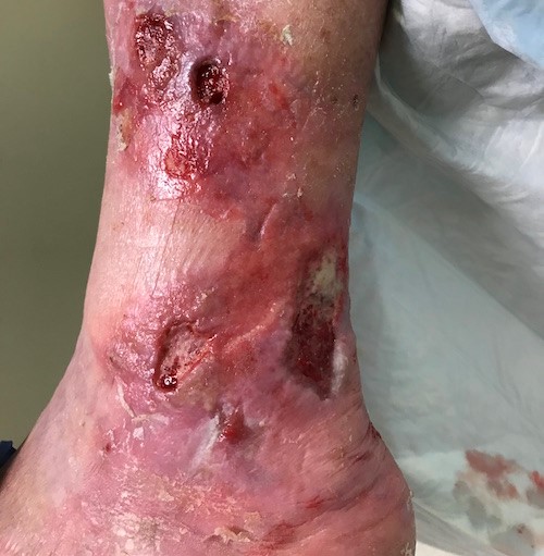 Wound with no signs of infection, ready for another application