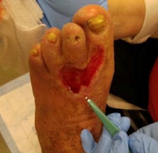 Debridement and hemostasis complete, wound bed ready for CTP application 