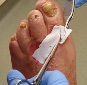  Placement of reticular dermis on wound, cut CTP to size    