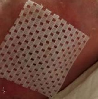 Non-adherent silicone contact layer is applied over the CTP