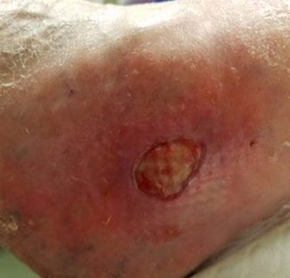  Appearance 1 week after application of CTP, preparing wound for CTP reapplication