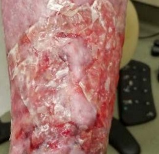  CTP applied on heavily exudative wound      