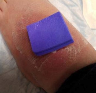  CTP applied on ulcer, covered with silicone contact layer and antimicrobial dressin