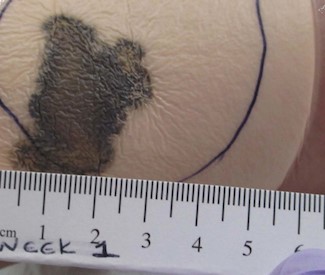 Circle drawn on cover dressing. If strikethrough goes beyond circle, call provider