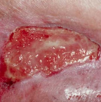 Caramelized appearance 1 week post application of CTP