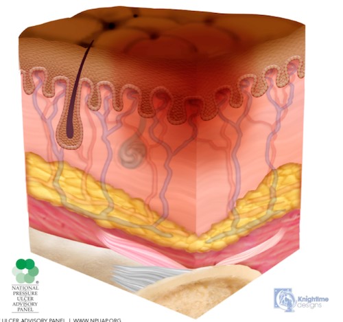 Stage 1 pressure ulcer/injury, darkly pigmented skin
