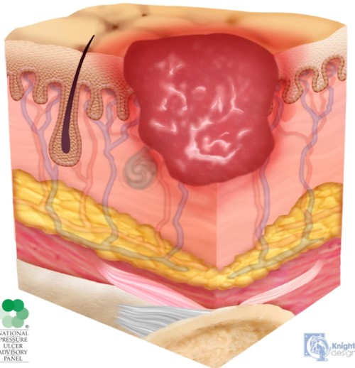 Stage 2 Pressure Ulcer/Injury