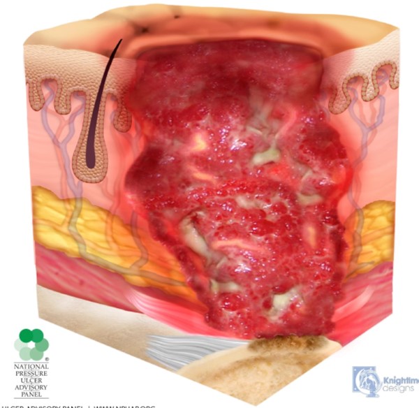 Stage 4 Pressure ulcer/injury