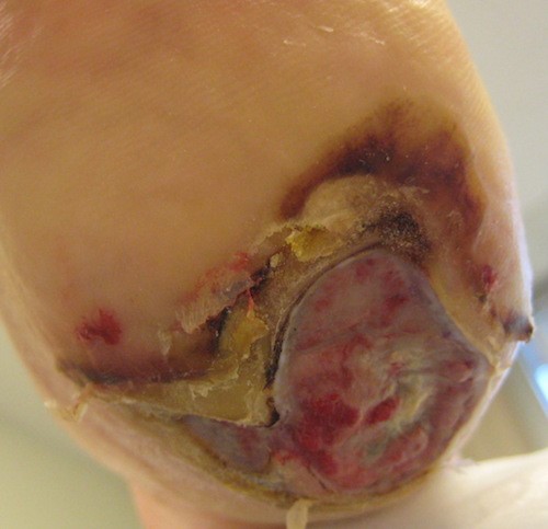 Unstageable pressure ulcer/injury in the heel . Lebendiskaya N, RN,BSN, CWOCN