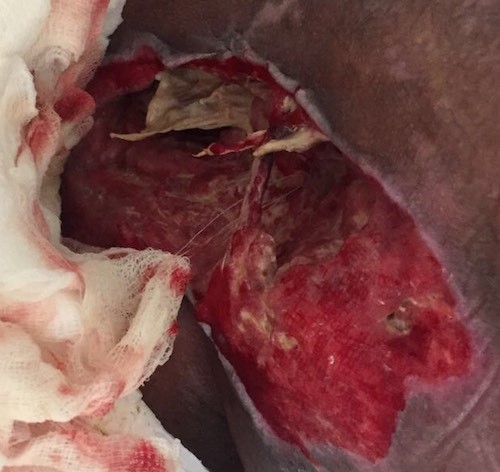 Stage 4 Pressure ulcer/injury in the sacral region. Ishizuka CK, MD