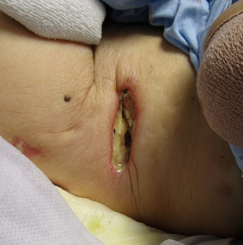 Stage 3 Pressure ulcer/injury left trochanteric region. Ishizuka CK, MD