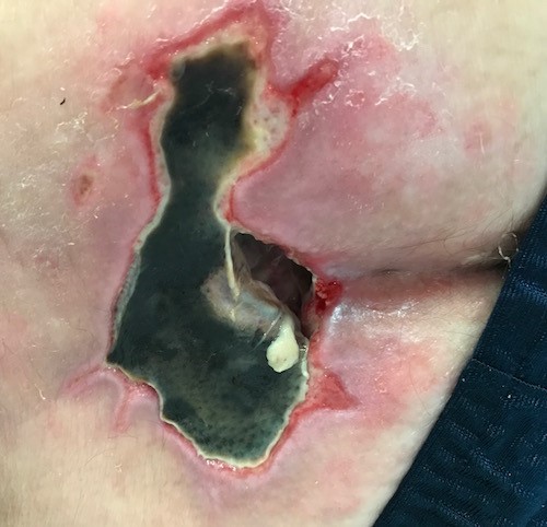 Unstageable sacral ulcer. Robinson S, MD