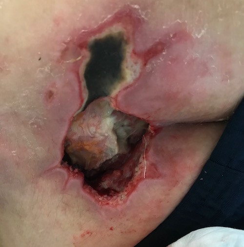 Sacral pressure ulcer/injury - Stage 4. Robinson S, MD