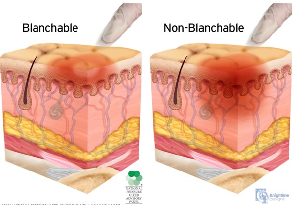 Blanchable erythema (normal reactive hyperemia) and non-blanchable erythema (Stage 1 PU/PI)