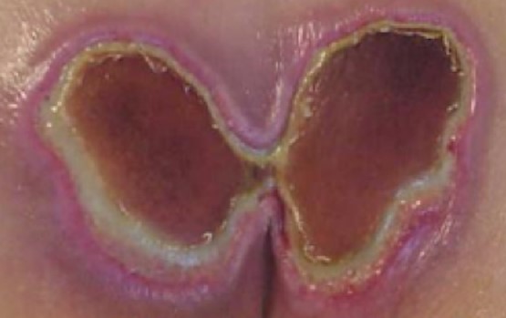 Kennedy Terminal Ulcer - butterfly shaped