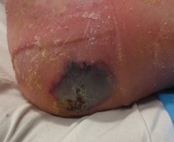 Deep tissue injury in the heel. Lebendiskaya N, RN, BSN, CWOCN