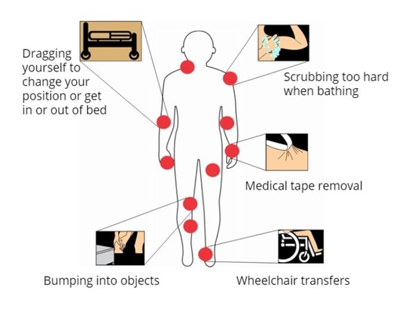 Common locations and causes of skin tears