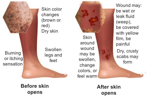 Venous Ulcer Wound Dressing
