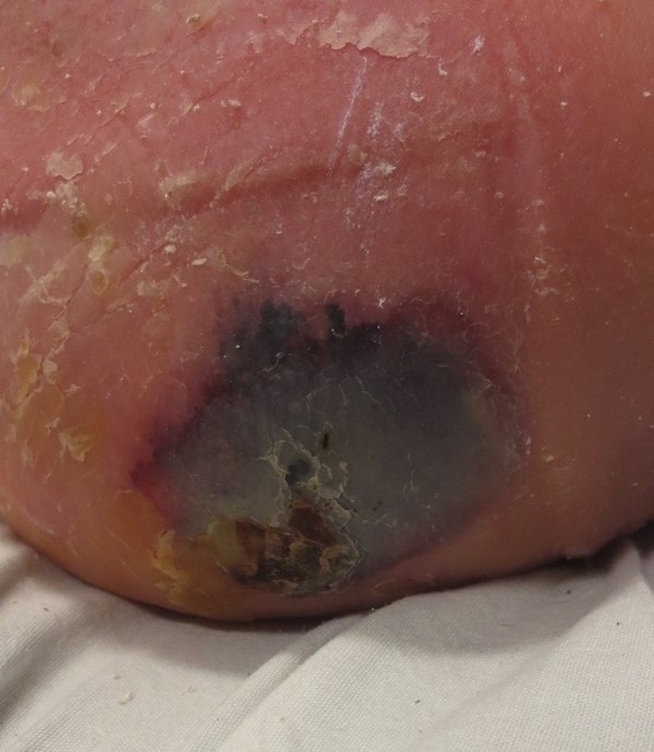 Deep tissue injury.By Lebendiskaya N. RN, BSN, CWOCN