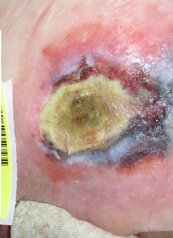 Evolving deep tissue injury. By Lebendiskaya N. RN, BSN, CWOCN