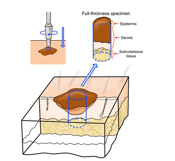 Punch biopsy