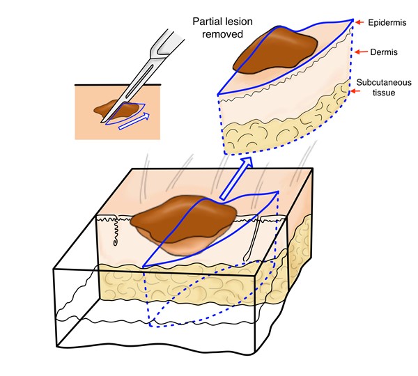 Incisional biopsy