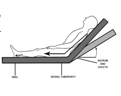 7. Shear forces resulting from head-of-bed elevation