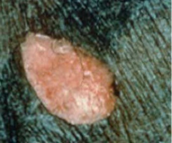 1. Stage 2 pressure ulcer/injury