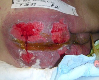 2. Incontinence associated dermatitis