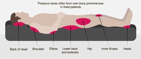 Common pressure ulcers/injuries locations