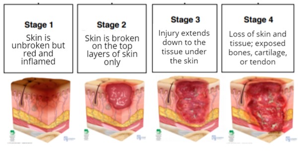 Stages of pressure ulcers/injuries (NPIAP)