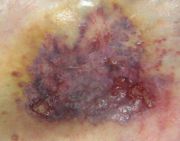Ulcerative pyoderma gangrenusum, early lesion