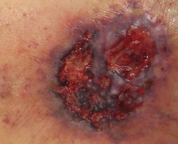 A more advanced ulcerative pyoderma gangrenosum.