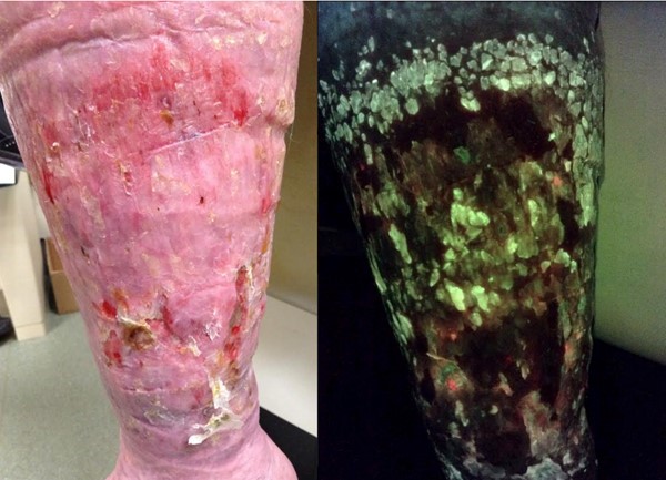 Fluorescence imaging for detection of higher bacterial loads (By Cathy Milne, APRN, MSN, CWOCN-AP)