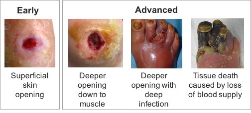 diabetic foot ulcer stages